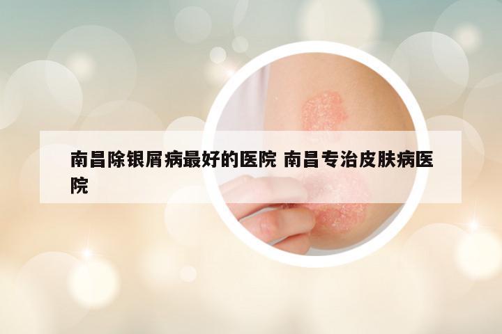 南昌除银屑病最好的医院 南昌专治皮肤病医院