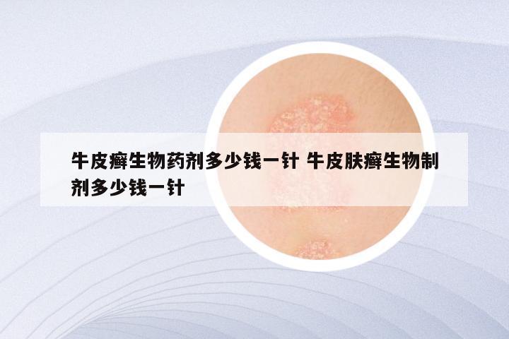 牛皮癣生物药剂多少钱一针 牛皮肤癣生物制剂多少钱一针