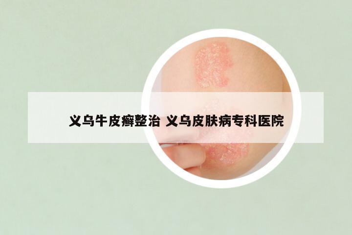 义乌牛皮癣整治 义乌皮肤病专科医院