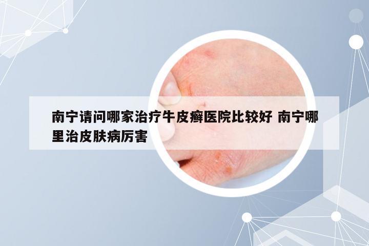 南宁请问哪家治疗牛皮癣医院比较好 南宁哪里治皮肤病厉害