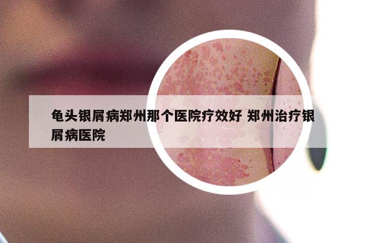 龟头银屑病郑州那个医院疗效好 郑州治疗银屑病医院