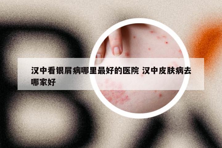 汉中看银屑病哪里最好的医院 汉中皮肤病去哪家好