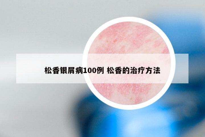 松香银屑病100例 松香的治疗方法