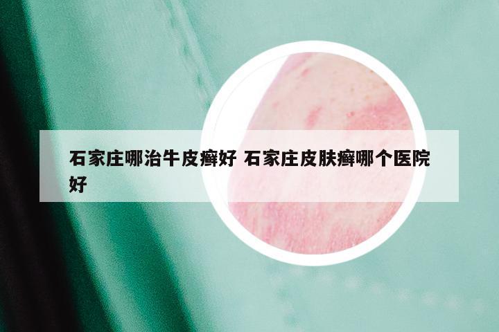 石家庄哪治牛皮癣好 石家庄皮肤癣哪个医院好