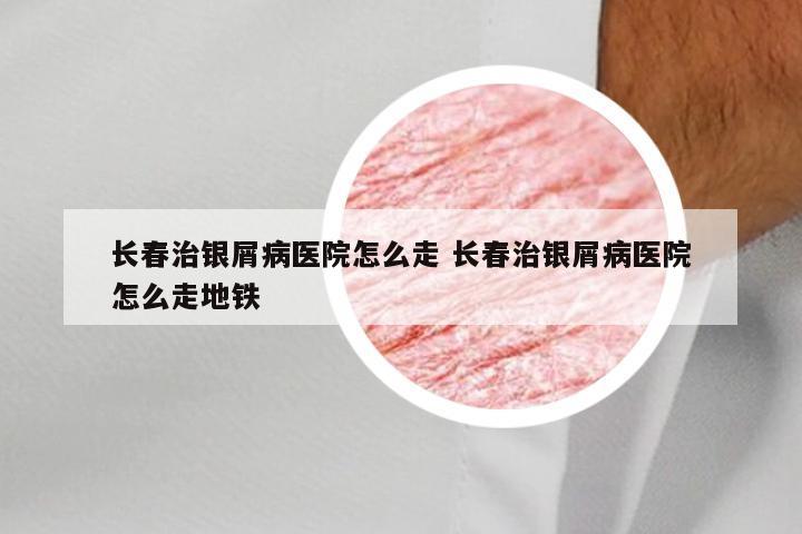 长春治银屑病医院怎么走 长春治银屑病医院怎么走地铁