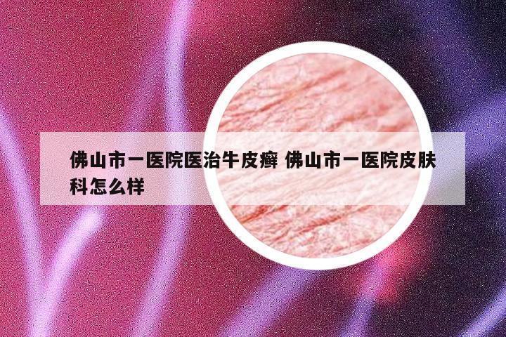佛山市一医院医治牛皮癣 佛山市一医院皮肤科怎么样