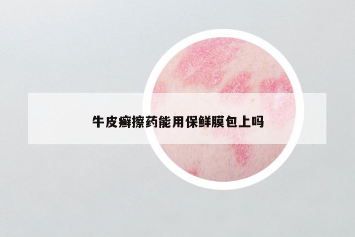 牛皮癣擦药能用保鲜膜包上吗