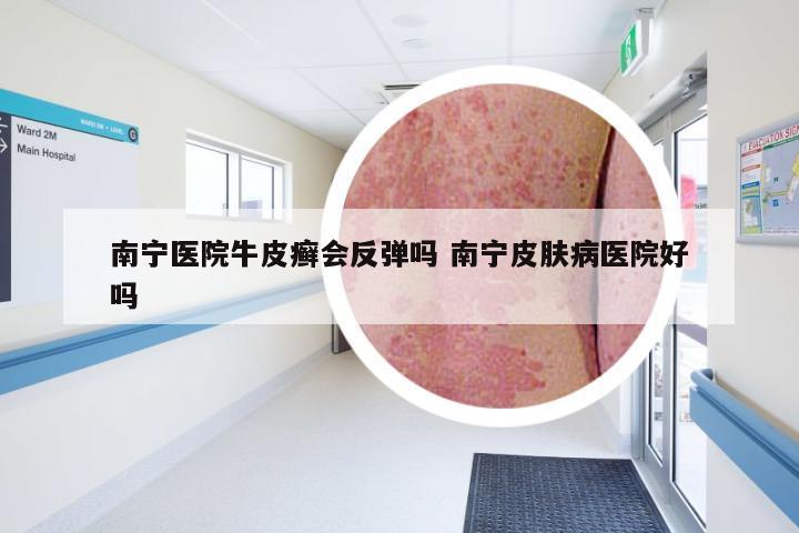 南宁医院牛皮癣会反弹吗 南宁皮肤病医院好吗