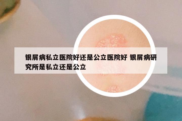 银屑病私立医院好还是公立医院好 银屑病研究所是私立还是公立