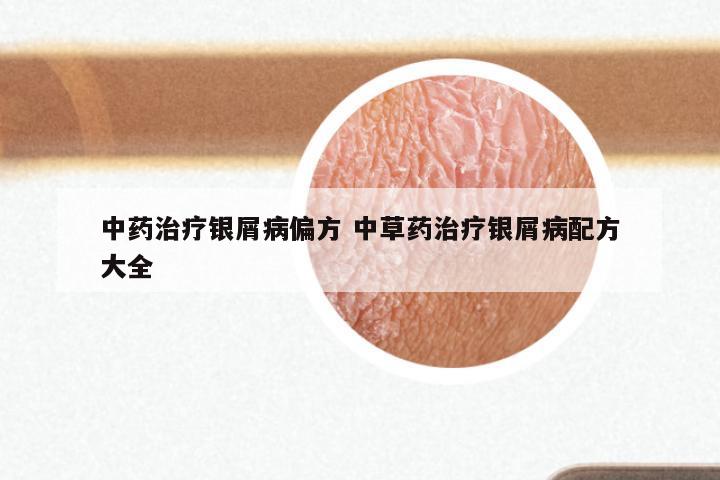 中药治疗银屑病偏方 中草药治疗银屑病配方大全