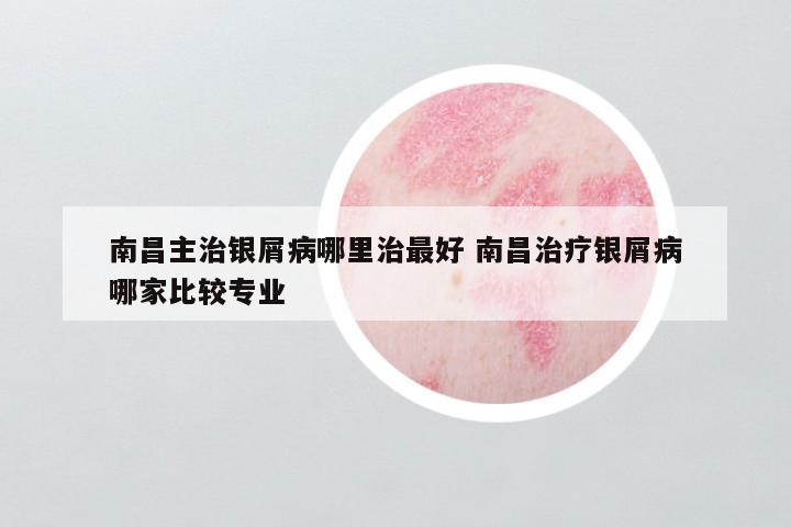 南昌主治银屑病哪里治最好 南昌治疗银屑病哪家比较专业