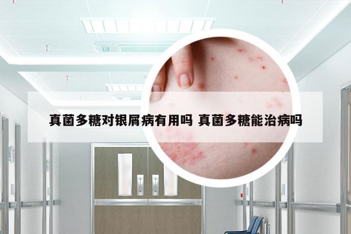 真菌多糖对银屑病有用吗 真菌多糖能治病吗