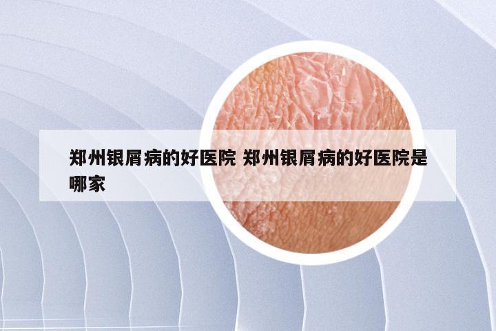 郑州银屑病的好医院 郑州银屑病的好医院是哪家