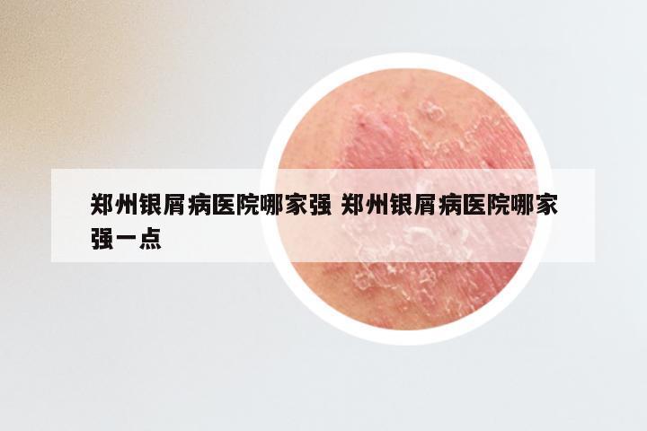郑州银屑病医院哪家强 郑州银屑病医院哪家强一点