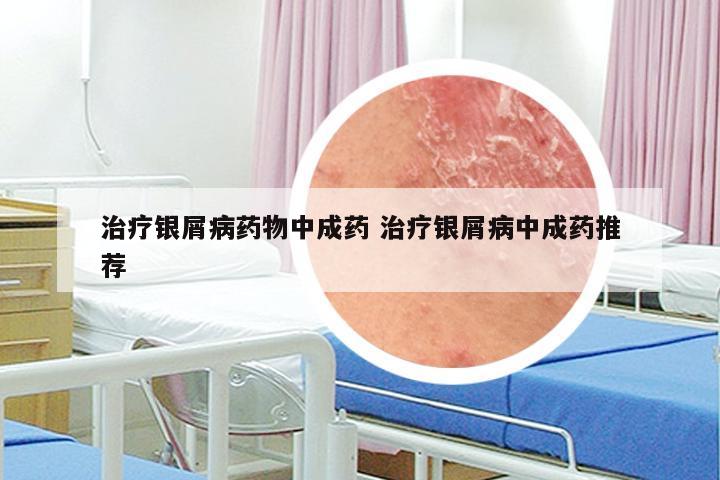 治疗银屑病药物中成药 治疗银屑病中成药推荐