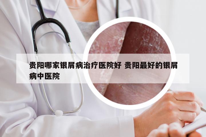 贵阳哪家银屑病治疗医院好 贵阳最好的银屑病中医院