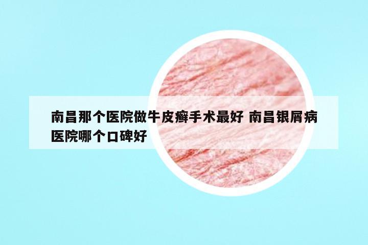 南昌那个医院做牛皮癣手术最好 南昌银屑病医院哪个口碑好
