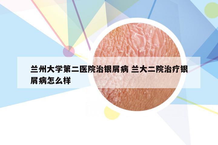 兰州大学第二医院治银屑病 兰大二院治疗银屑病怎么样