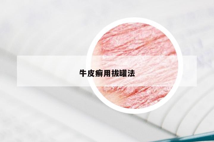 牛皮癣用拔罐法