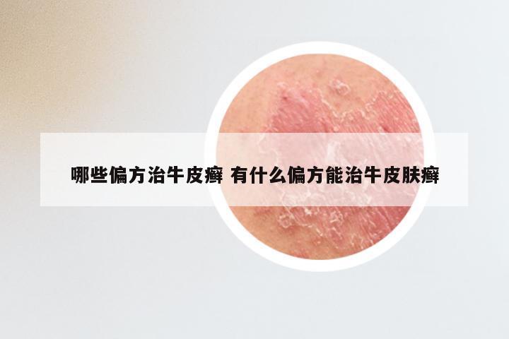 哪些偏方治牛皮癣 有什么偏方能治牛皮肤癣