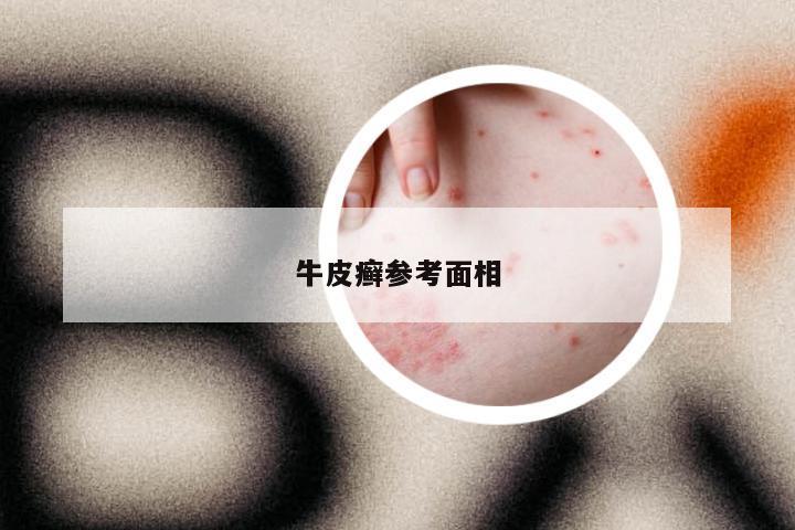 牛皮癣参考面相