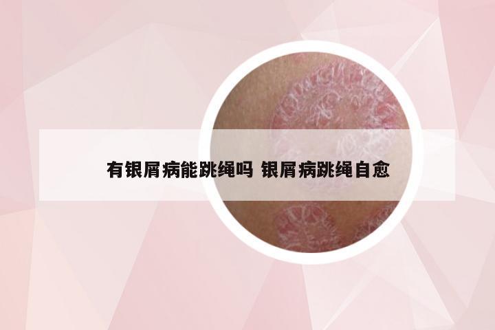 有银屑病能跳绳吗 银屑病跳绳自愈