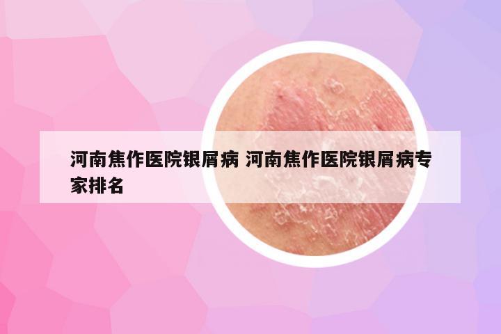 河南焦作医院银屑病 河南焦作医院银屑病专家排名