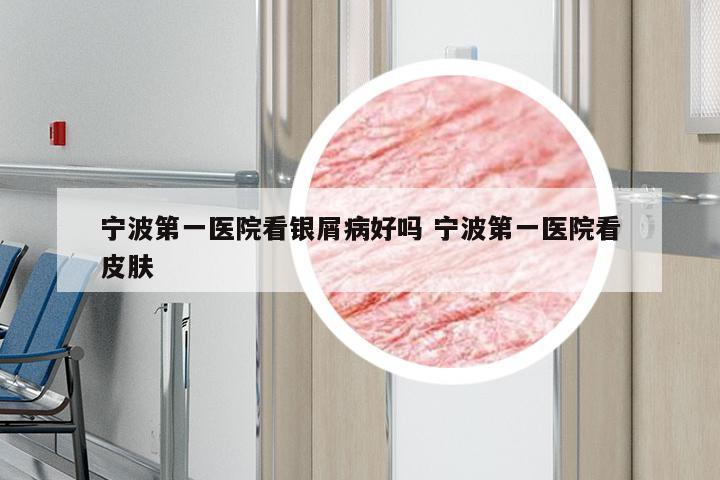 宁波第一医院看银屑病好吗 宁波第一医院看皮肤