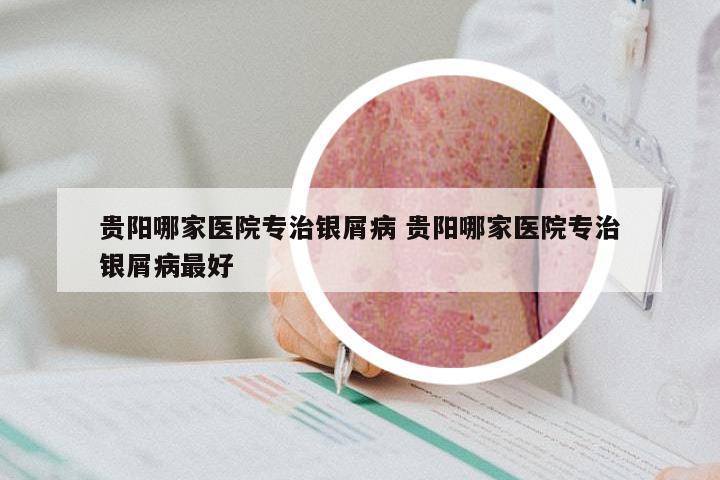 贵阳哪家医院专治银屑病 贵阳哪家医院专治银屑病最好