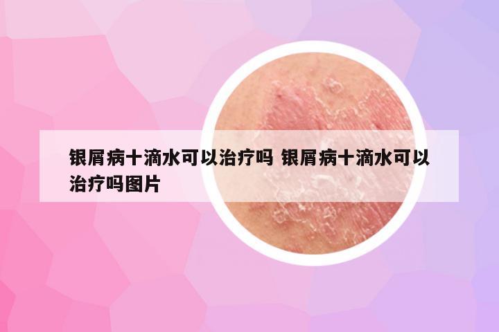 银屑病十滴水可以治疗吗 银屑病十滴水可以治疗吗图片