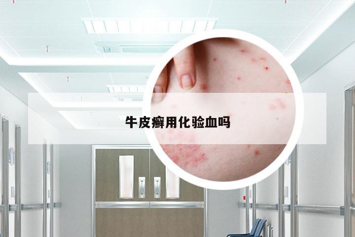 牛皮癣用化验血吗
