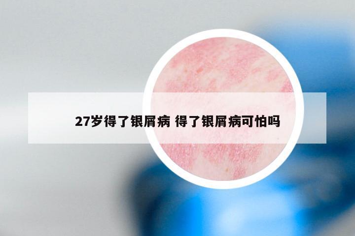 27岁得了银屑病 得了银屑病可怕吗