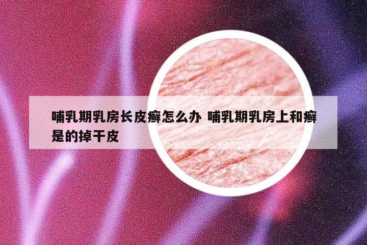 哺乳期乳房长皮癣怎么办 哺乳期乳房上和癣是的掉干皮