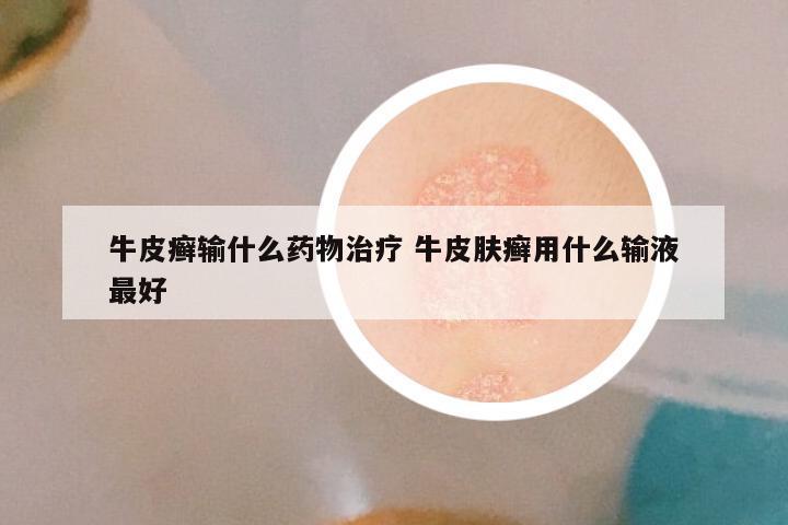 牛皮癣输什么药物治疗 牛皮肤癣用什么输液最好