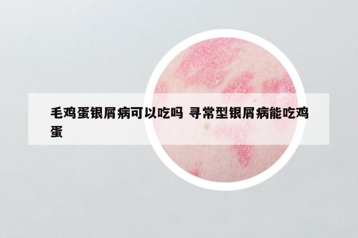 毛鸡蛋银屑病可以吃吗 寻常型银屑病能吃鸡蛋