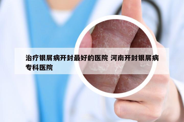 治疗银屑病开封最好的医院 河南开封银屑病专科医院
