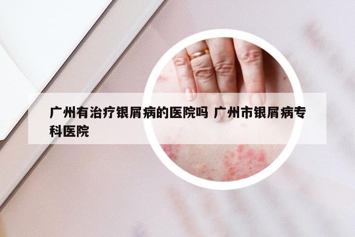 广州有治疗银屑病的医院吗 广州市银屑病专科医院
