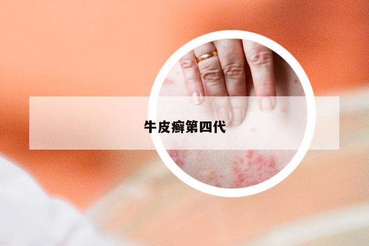 牛皮癣第四代
