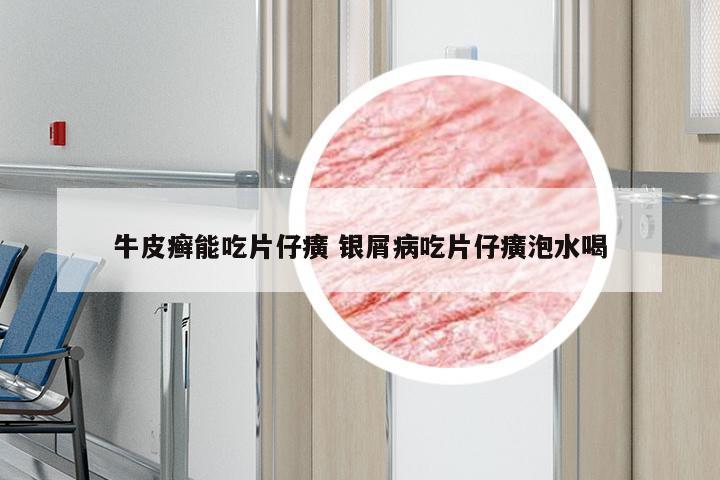 牛皮癣能吃片仔癀 银屑病吃片仔癀泡水喝