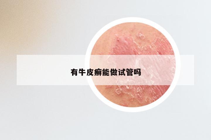 有牛皮癣能做试管吗