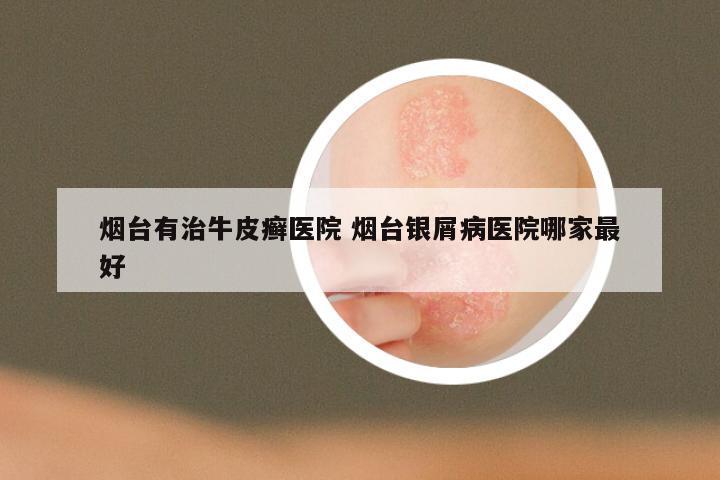 烟台有治牛皮癣医院 烟台银屑病医院哪家最好