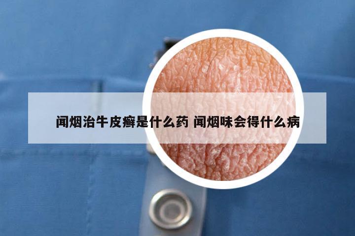 闻烟治牛皮癣是什么药 闻烟味会得什么病