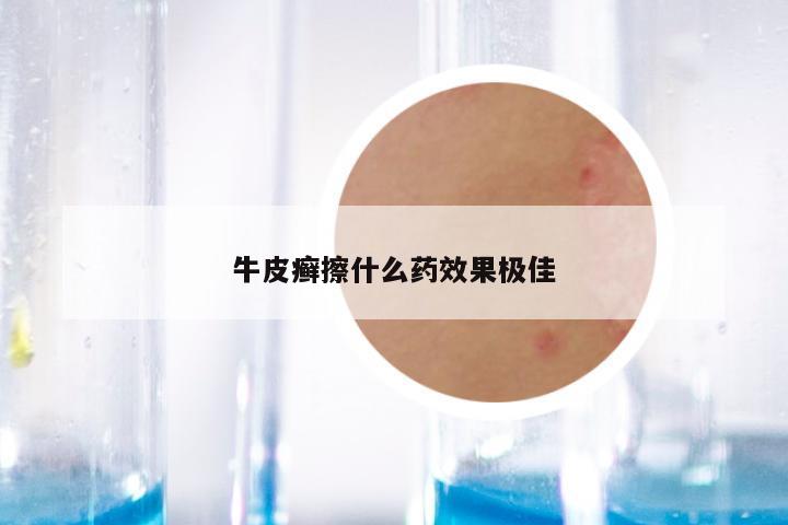 牛皮癣擦什么药效果极佳