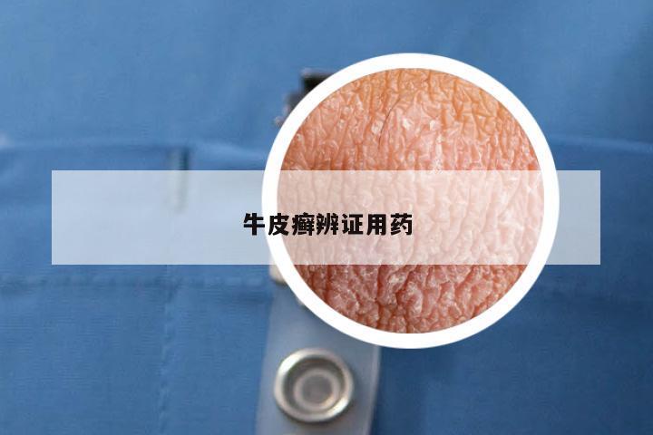 牛皮癣辨证用药