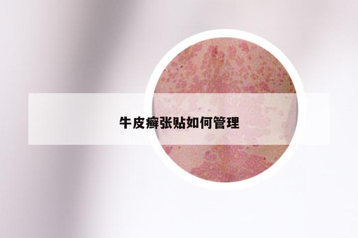 牛皮癣张贴如何管理