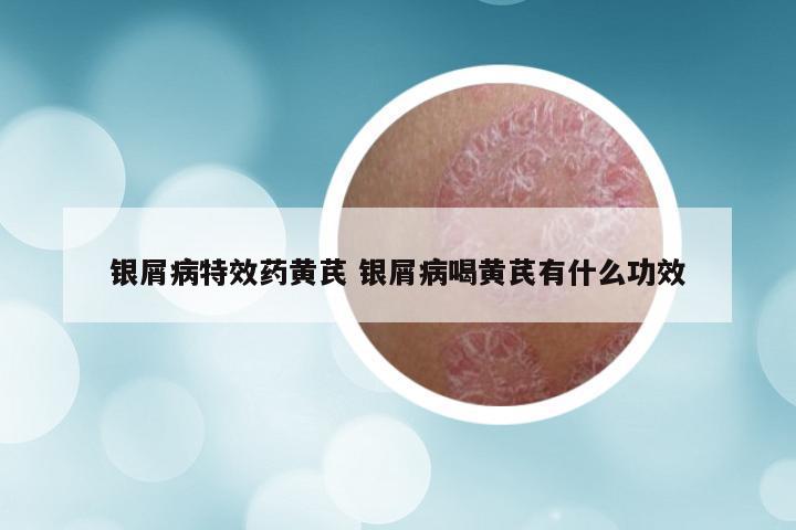 银屑病特效药黄芪 银屑病喝黄芪有什么功效