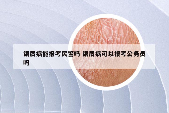 银屑病能报考民警吗 银屑病可以报考公务员吗