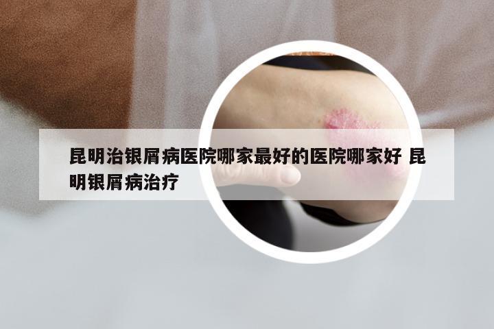 昆明治银屑病医院哪家最好的医院哪家好 昆明银屑病治疗