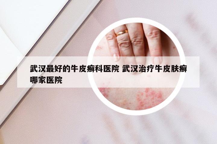 武汉最好的牛皮癣科医院 武汉治疗牛皮肤癣哪家医院