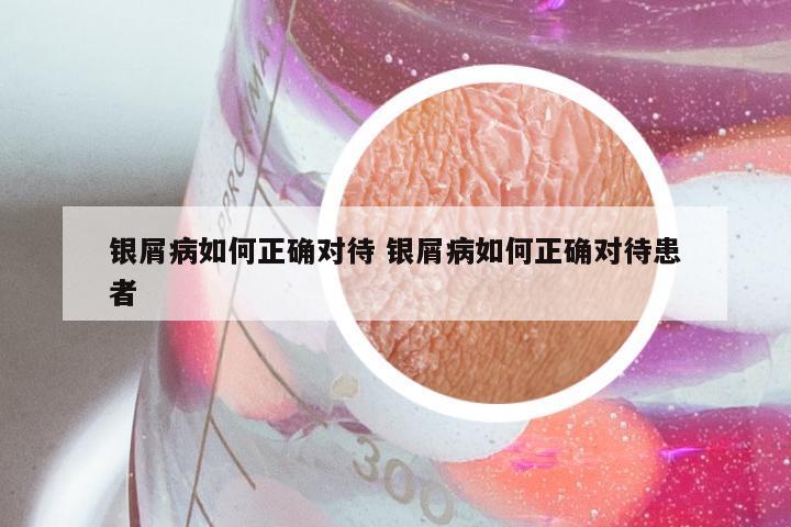 银屑病如何正确对待 银屑病如何正确对待患者